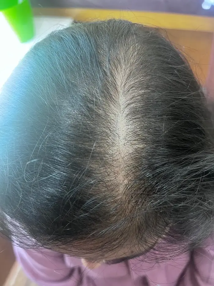 Female Pattern Baldness case 6 before treatment